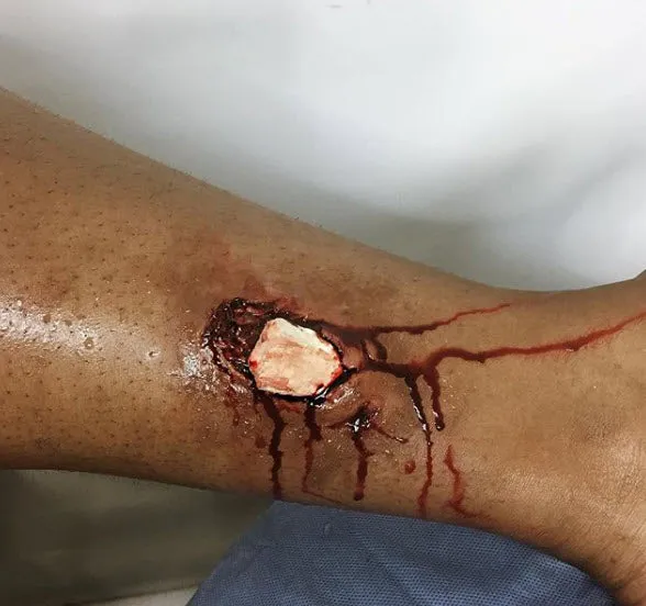 3D FX Transfers "Bone fracture" - Image 3